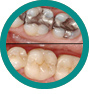 Obturatie - CMI DentalCare - dentistiasi.ro